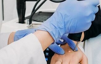 kārpu noņemšanas veidi