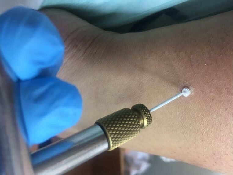 kārpu noņemšanas veidi