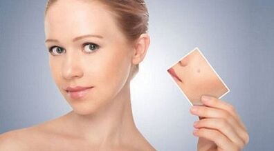 pārskats par efektīviem līdzekļiem kārpu un papilomu ārstēšanai