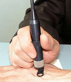 Papilloma ārstēšana