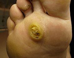 Subanārā papiloma